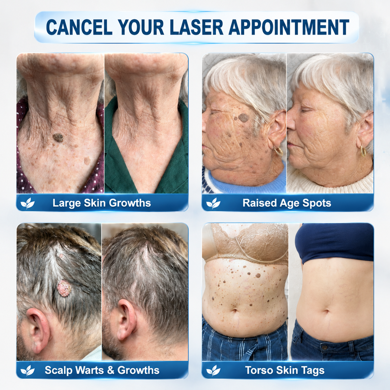 𝖧𝖨𝖲𝖪𝖨𝖭®👩‍⚕️⭐ 𝟕-𝐃𝒂𝘆 𝐒𝗸𝐢𝐧 𝐓𝒂𝗴 & 𝐒𝐩𝙤𝐭 𝐄𝐫𝒂𝐬𝙚𝐫 Painless & Scar-Free Advanced Imperfection Removal Rollerball Pen