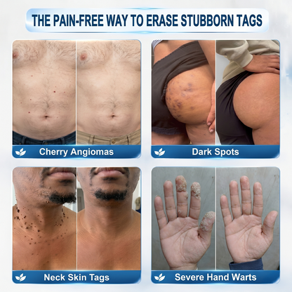 𝖧𝖨𝖲𝖪𝖨𝖭®👩‍⚕️⭐ 𝟕-𝐃𝒂𝘆 𝐒𝗸𝐢𝐧 𝐓𝒂𝗴 & 𝐒𝐩𝙤𝐭 𝐄𝐫𝒂𝐬𝙚𝐫 Painless & Scar-Free Advanced Imperfection Removal Rollerball Pen