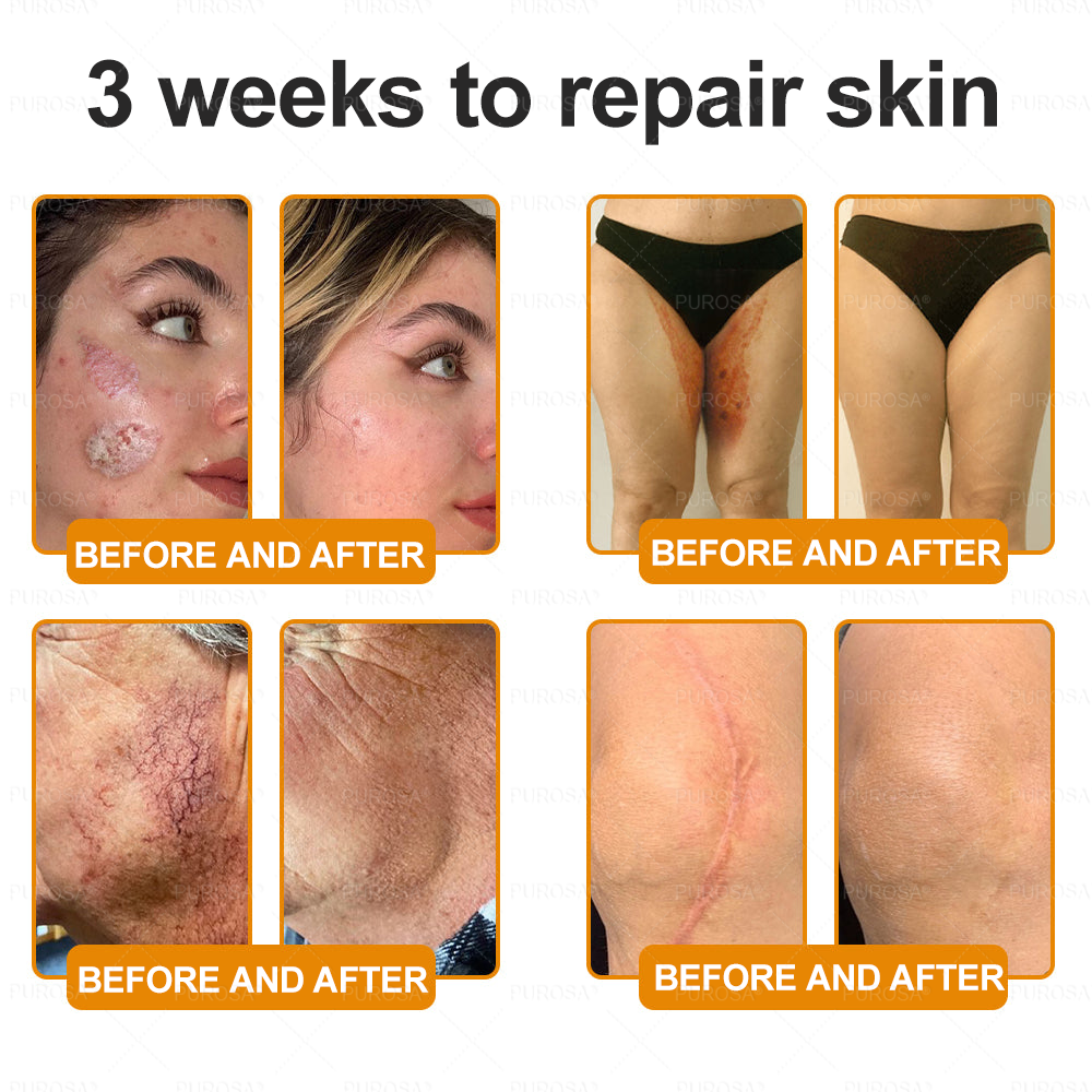 Made and Shipped from USA 🎇 VLSVLS® Bee Venom Skin Restoration Cream 🔥 LAST DAY 80% OFF🔅