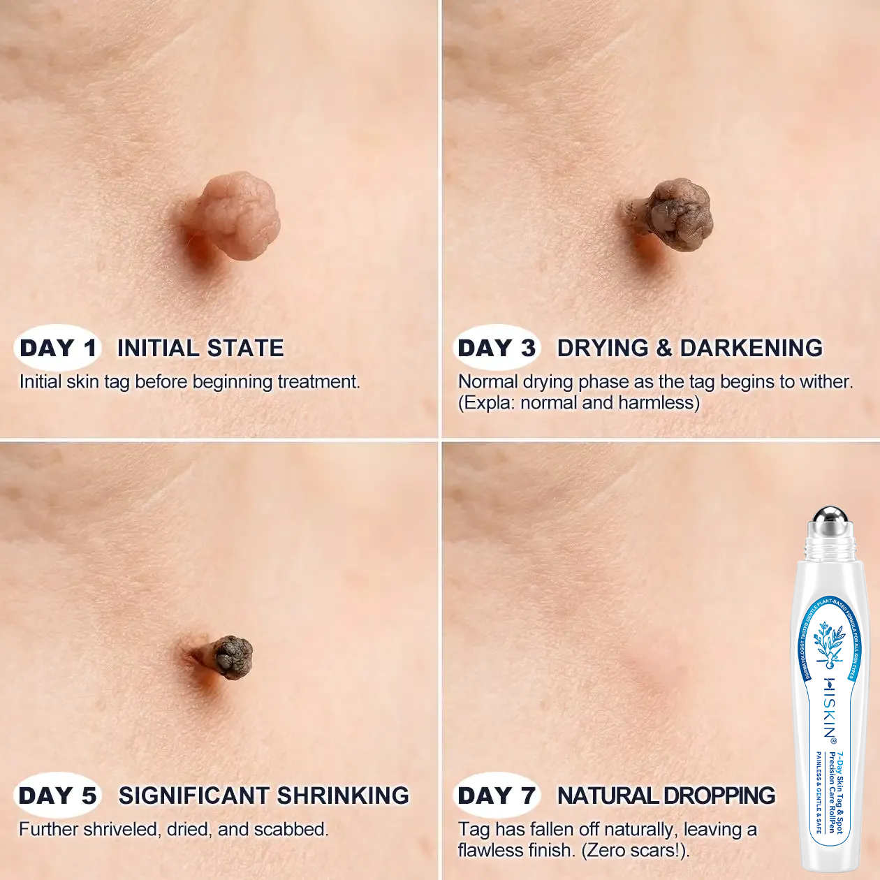 𝖧𝖨𝖲𝖪𝖨𝖭®👩‍⚕️⭐ 𝟕-𝐃𝒂𝘆 𝐒𝗸𝐢𝐧 𝐓𝒂𝗴 & 𝐒𝐩𝙤𝐭 𝐄𝐫𝒂𝐬𝙚𝐫 Painless & Scar-Free Advanced Imperfection Removal Rollerball Pen